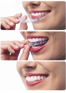 invisalign